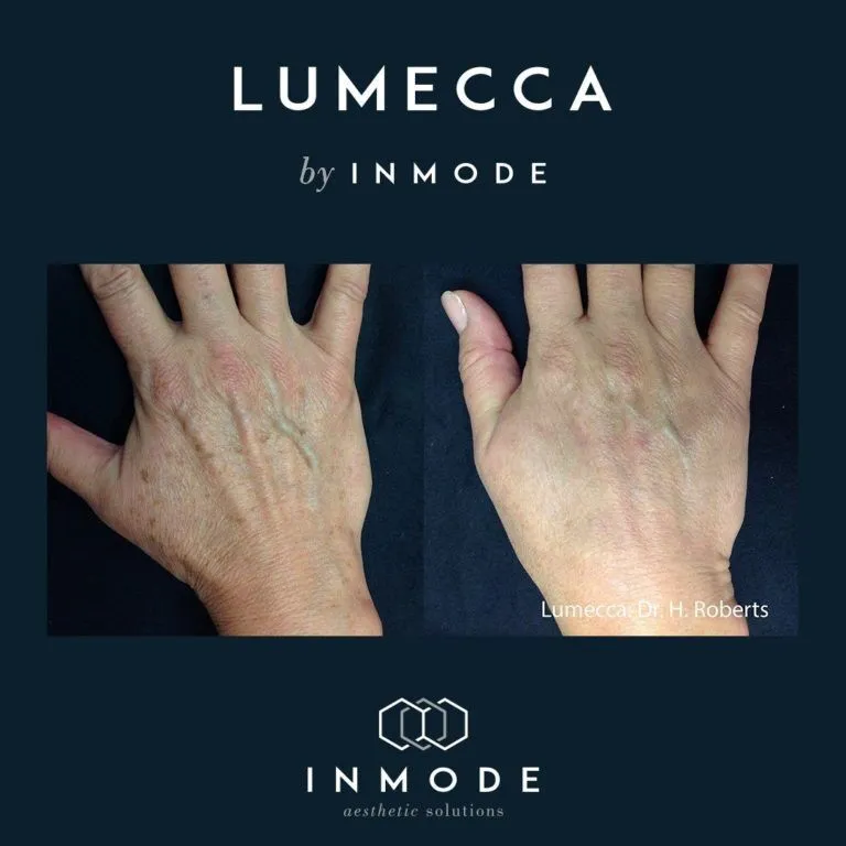 Lumecca hand