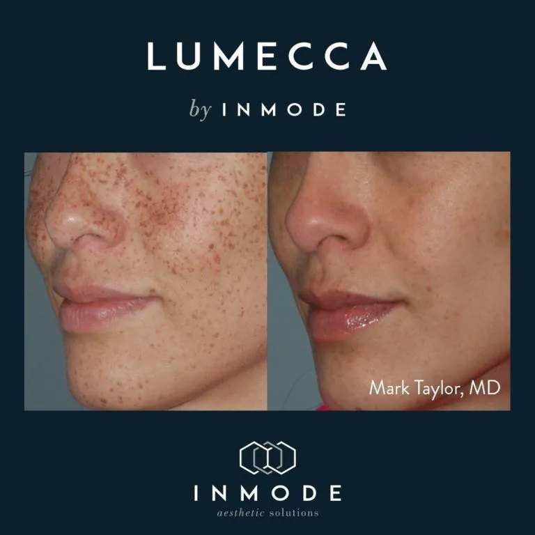 Lumecca laser before and after