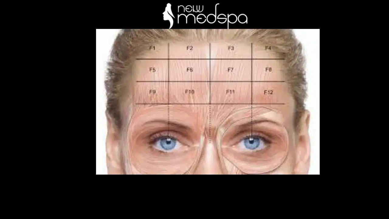 Procedure for Forehead Wrinkles