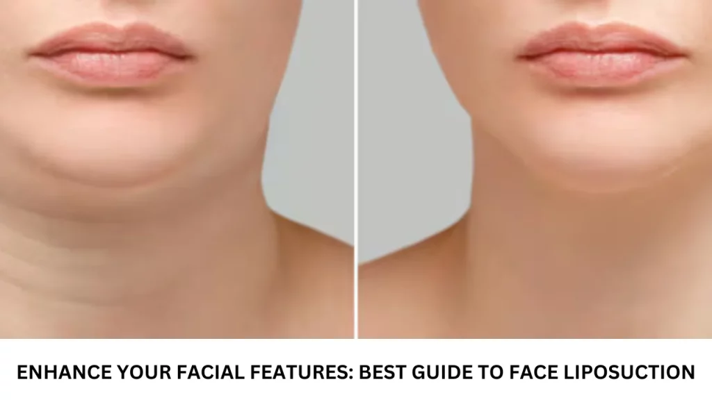 Face Liposuction