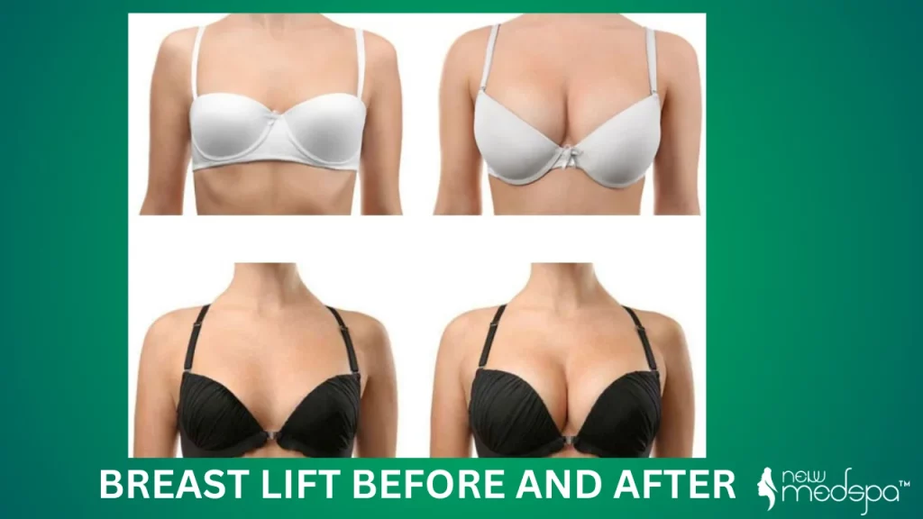 Breast Lift Before and After