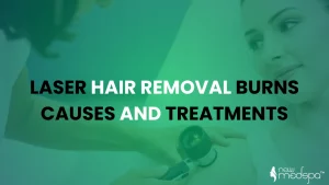 Laser Hair Removal Burns