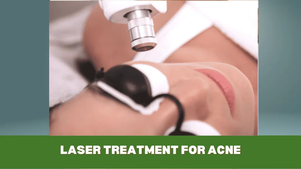 laser treatment for acne