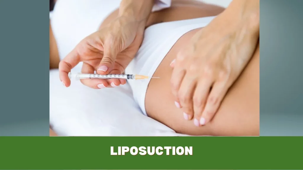 liposuction