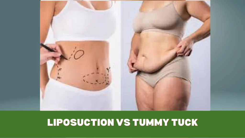 liposuction vs tummy tuck