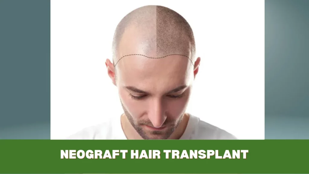 neograft hair transplant