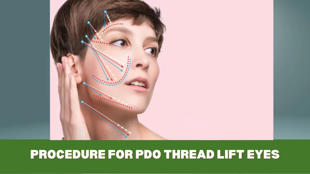 procedure for pdo thread lift eyes