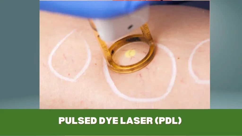 pulsed dye laser (pdl)