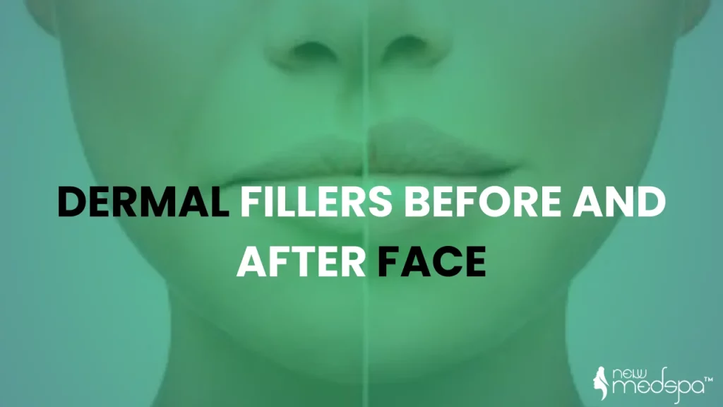 dermal fillers before and after face