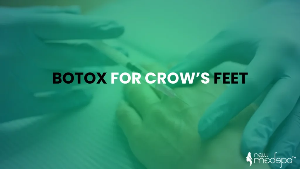 Botox for Crows Feet