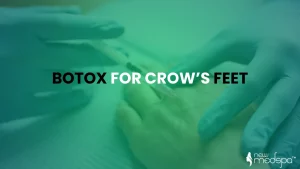 Botox for Crows Feet