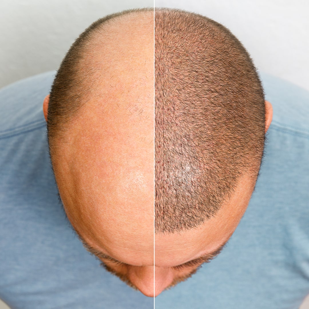 1/6 Joe ヘッド with Hair Implantation Merchant - This patient had 2,600 grafts placed to rebuild