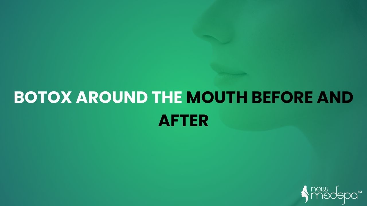 Botox Around the Mouth Before and After