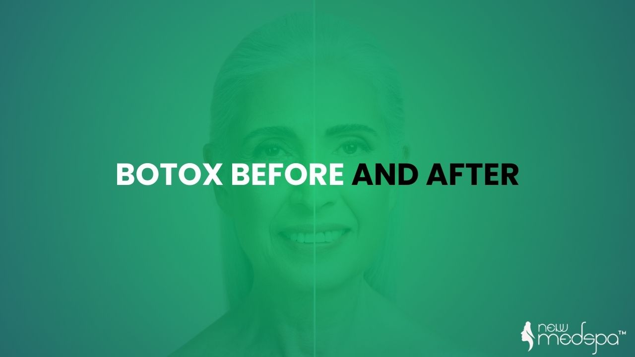 Botox Before and After