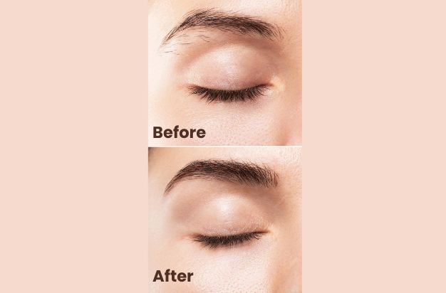 botox brow lift before and after result