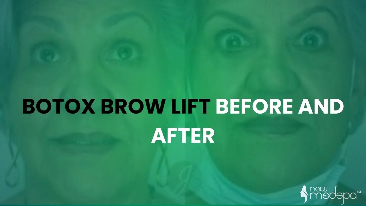 Botox Brow Lift Before and After