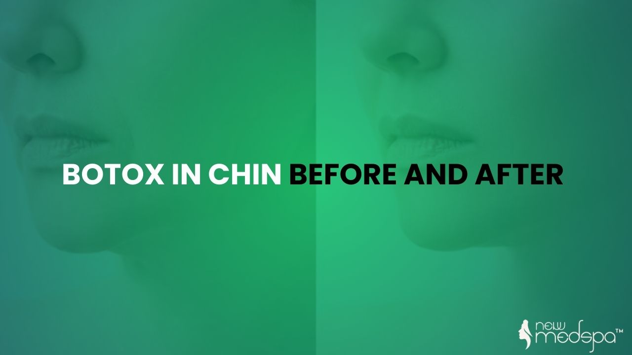 Botox in Chin Before and After