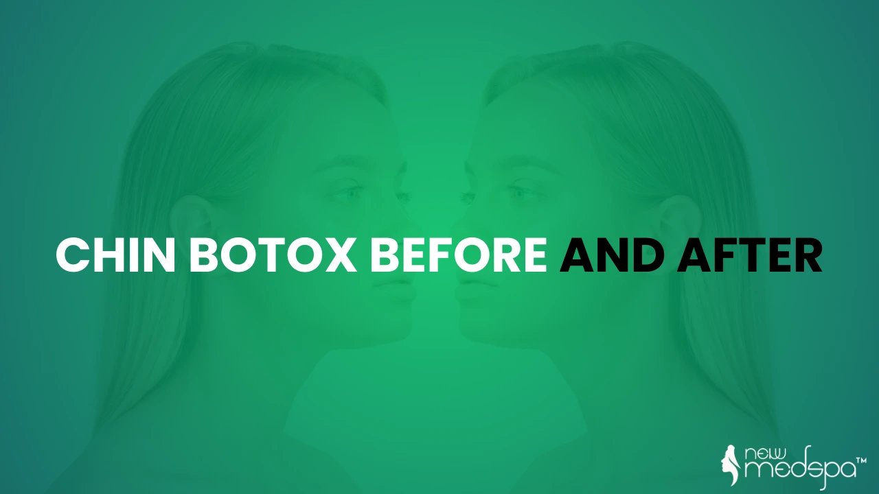 Chin Botox Before and After