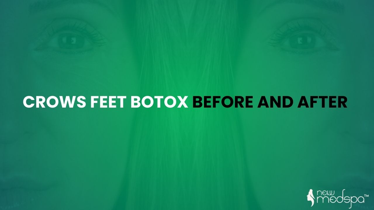 Crows Feet Botox Before and After