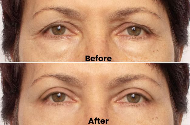 elderly woman under eye botox before after