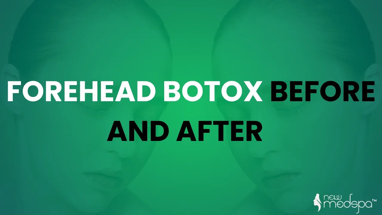 Forehead Botox Before and After