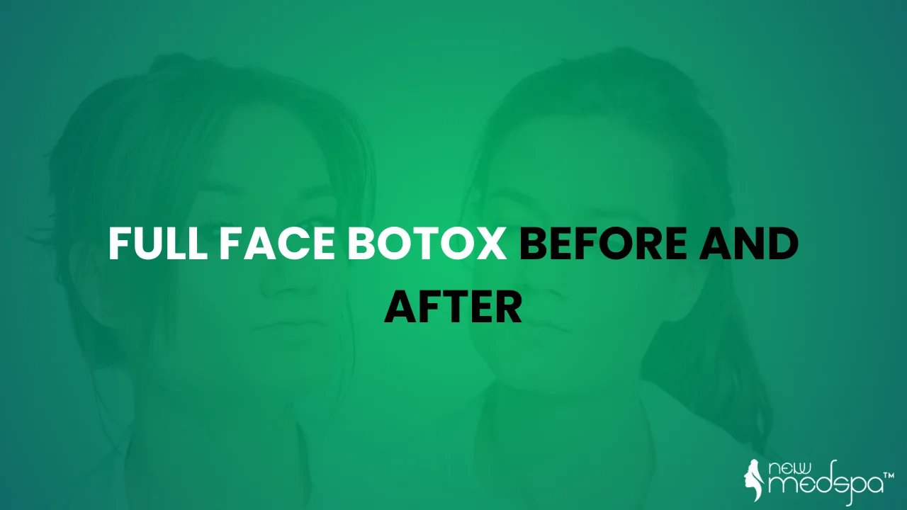 Full Face Botox Before and After