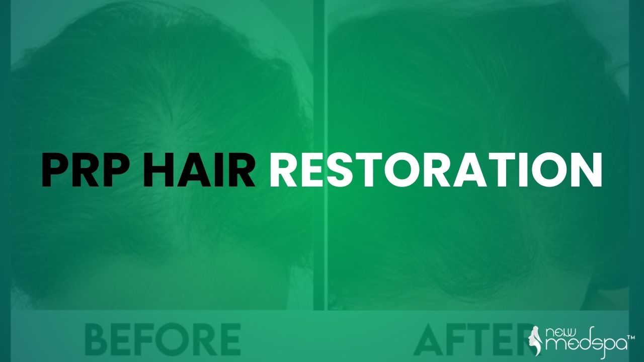 PRP Hair Restoration