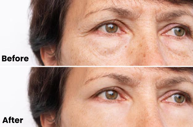 under eye botox before and after results