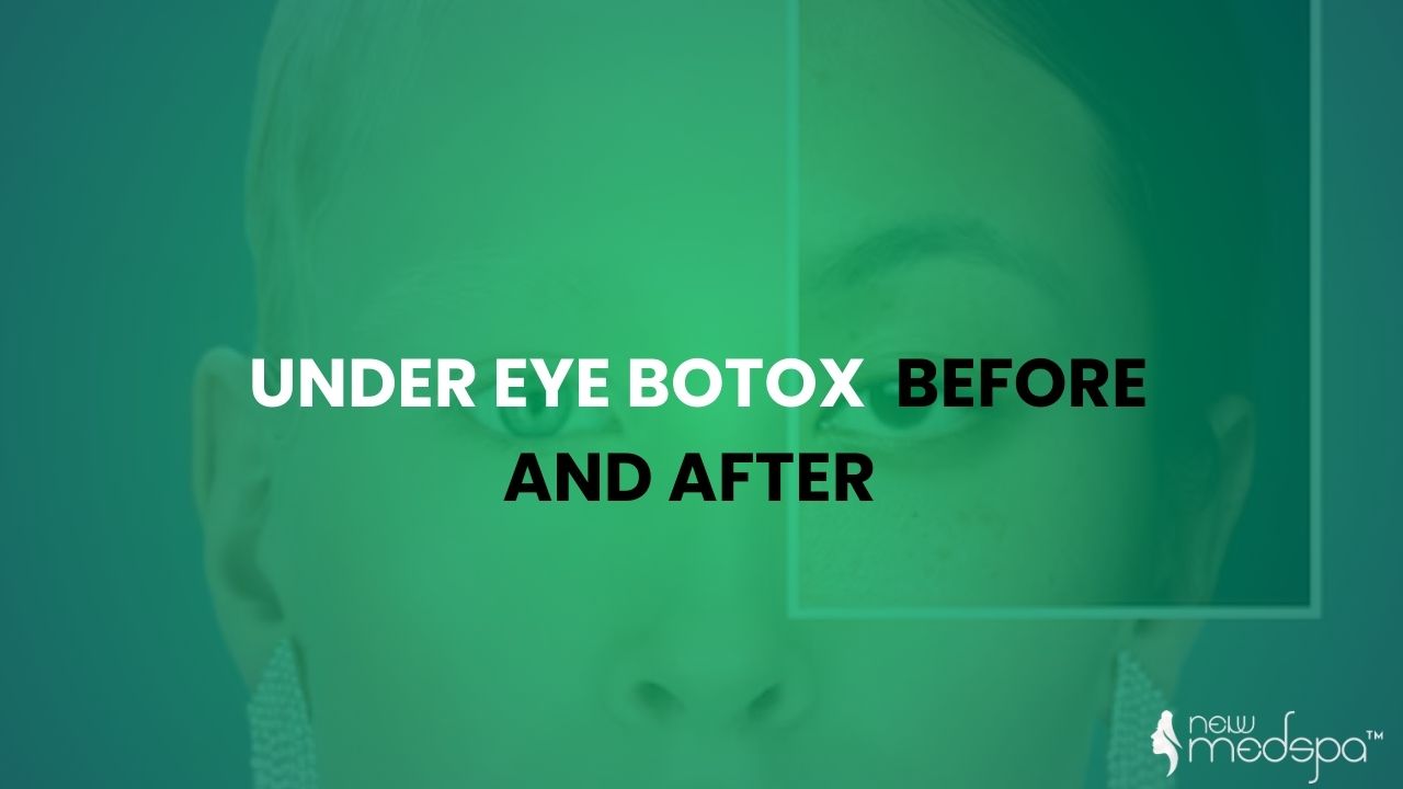 Under Eye Botox Before and After