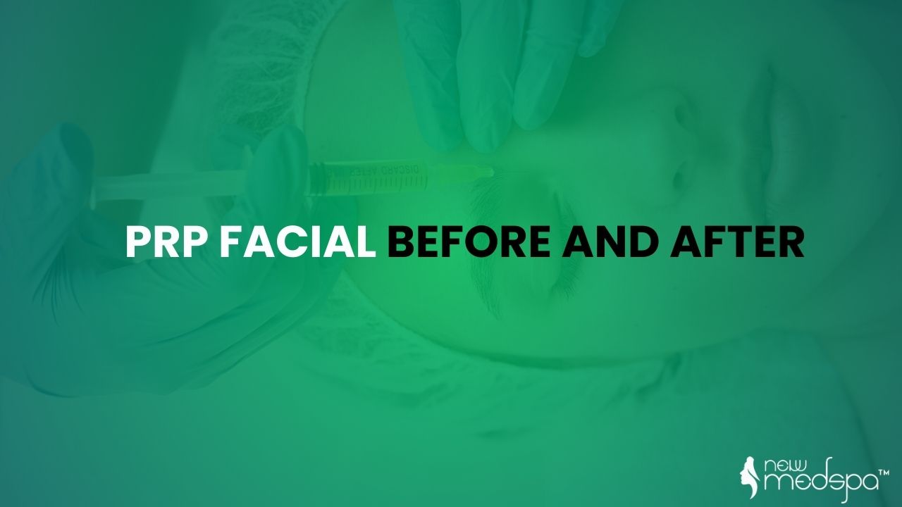 PRP facial before and after