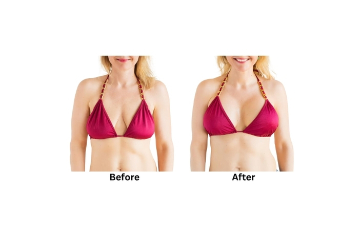 result before and after vampire breast lift