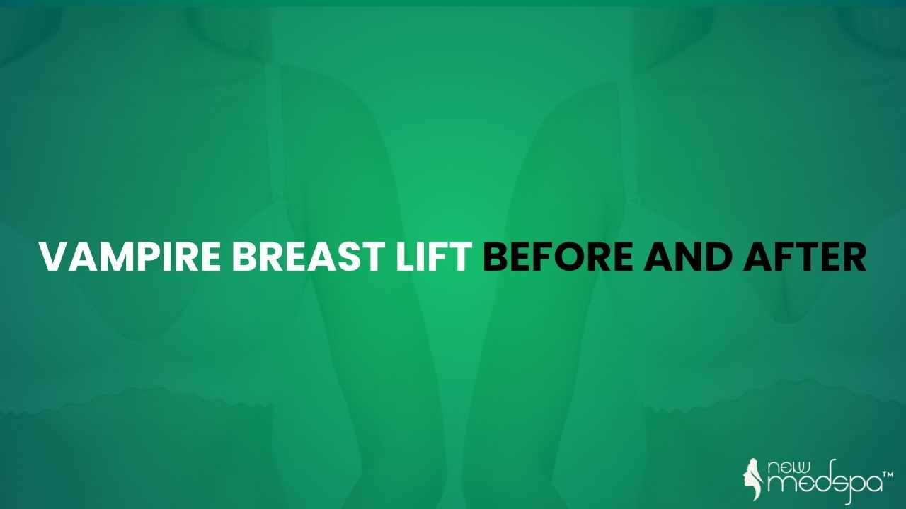 vampire breast lift before and after